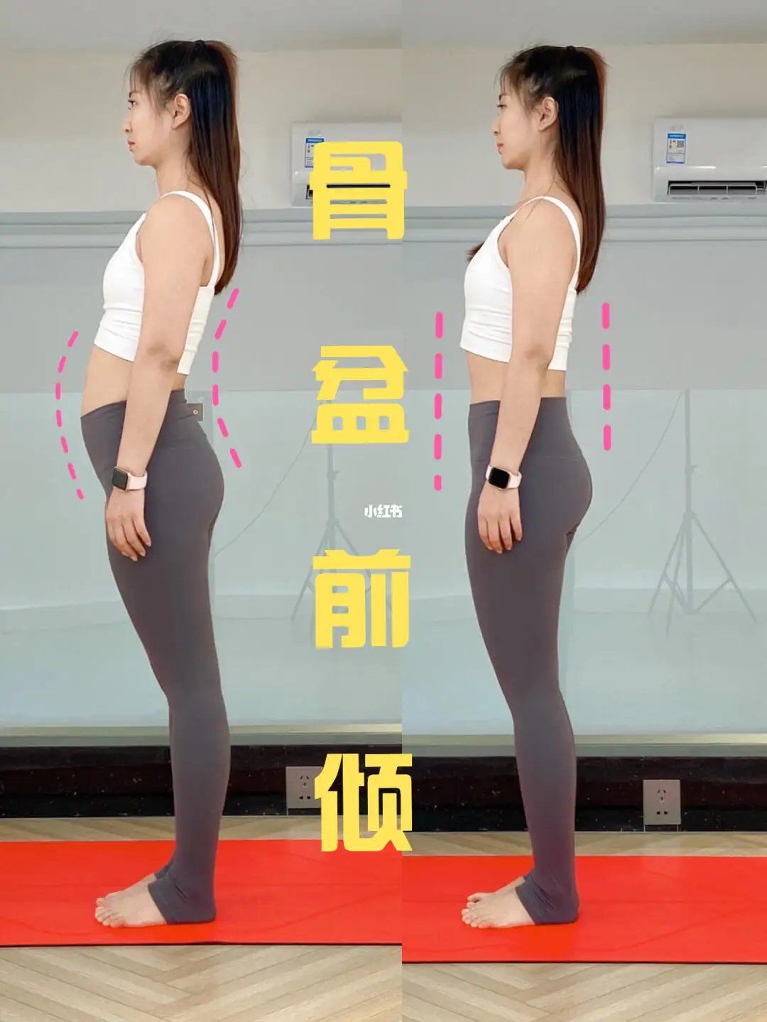 骨盆前倾是非常常见的一种体态问题,这种体