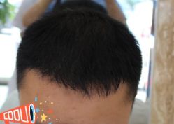 -大麦微针植发丨全国连锁