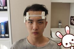 点击看大图 -大麦微针植发丨全国连锁