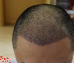 -大麦微针植发丨全国连锁