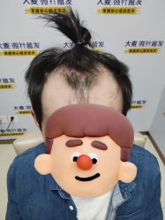 体验前-大麦微针植发丨全国连锁