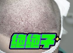 -大麦微针植发丨全国连锁