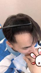 点击看大图 -大麦微针植发丨全国连锁