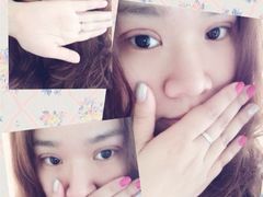 这个是今天第二天的状态&nbsp;拍摄角度问题&nbsp;所以看上去两眼有异-上海华安整形外科门诊部