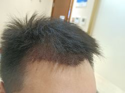 -碧莲盛·不剃发植发