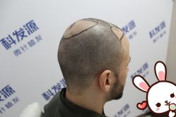 -大麦微针植发丨全国连锁