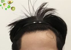 -大麦微针植发全国连锁
