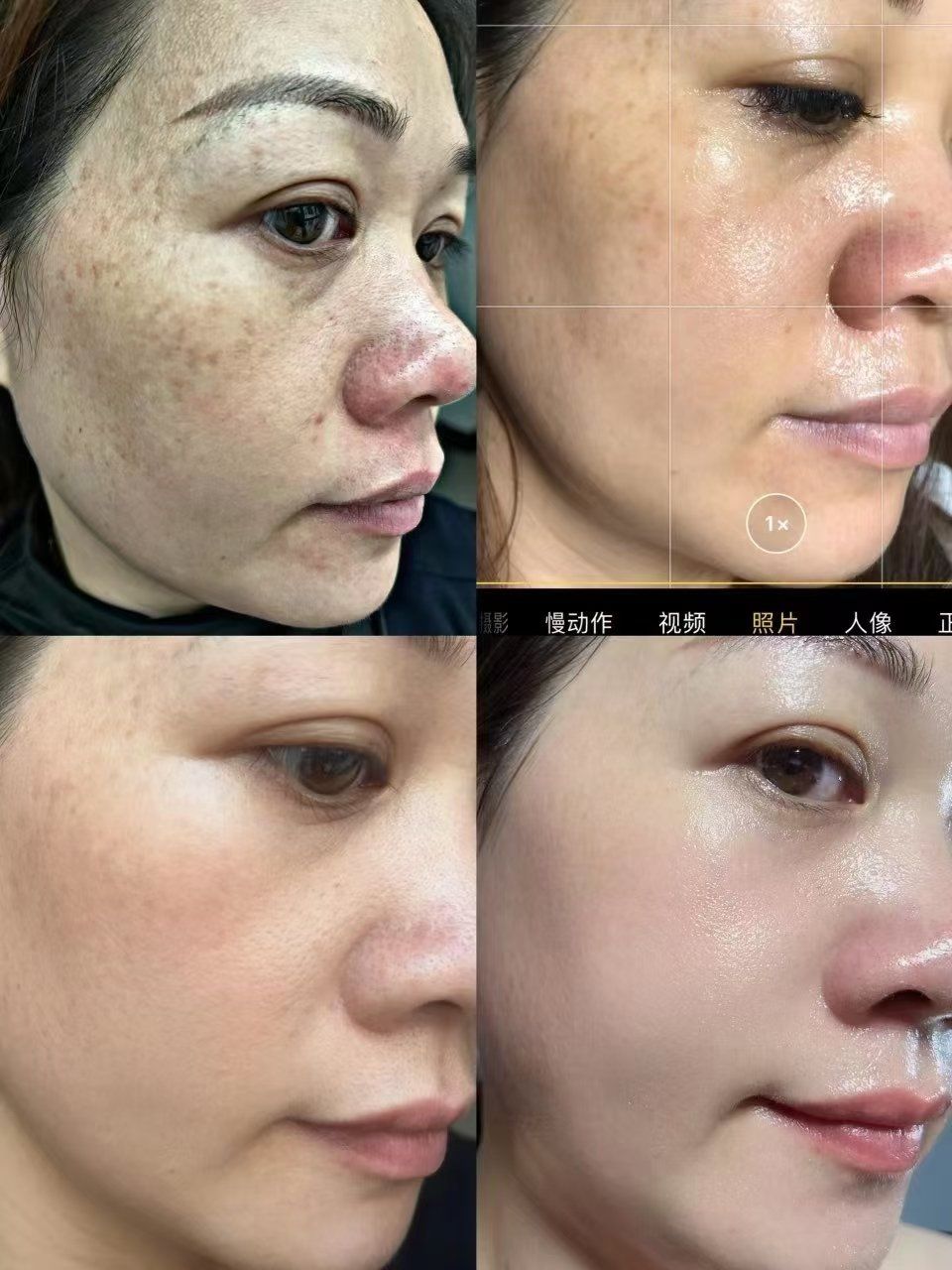 面部祛斑效果对比