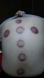 拔火罐后……-摩瘦纤体订制减肥