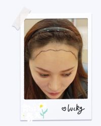 体验后-大麦微针植发全国连锁