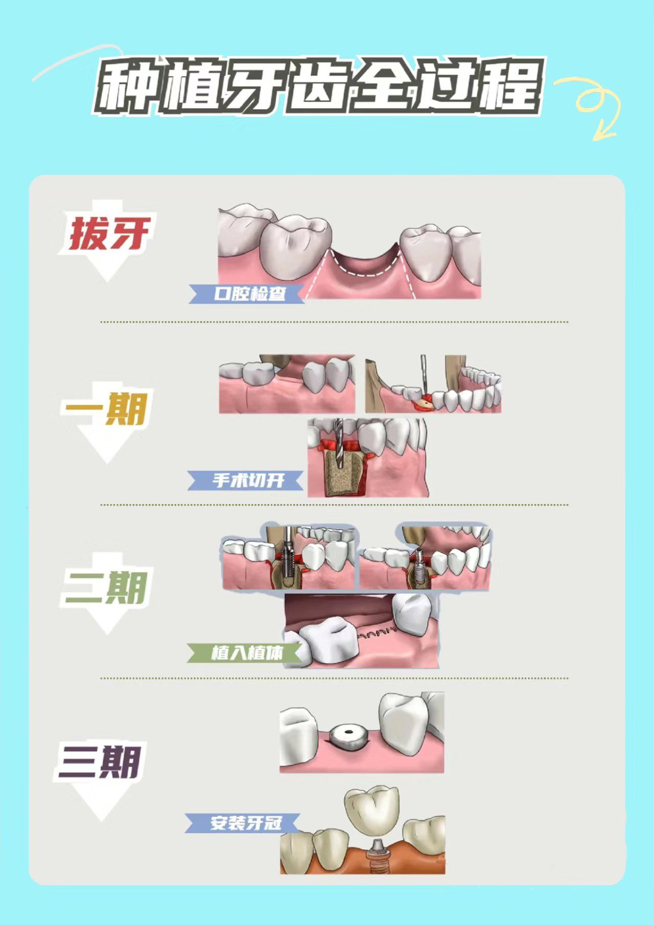 摘牙冠的过程图解图片