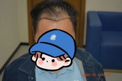 -大麦微针植发全国连锁