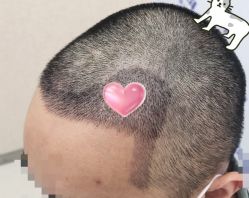 -大麦微针植发全国连锁