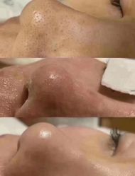 -成都苗方清颜专业祛痘