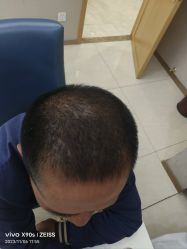 体验后-大麦微针植发丨全国连锁