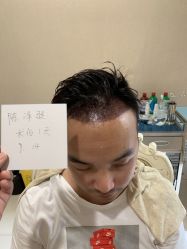 -大麦微针植发丨全国连锁