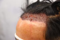 -大麦微针植发丨全国连锁