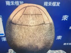 -雍禾植发全国连锁