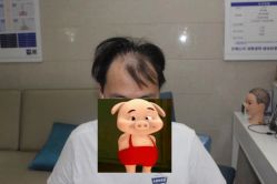 点击看大图 -大麦微针植发全国连锁