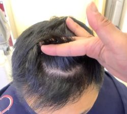 -大麦微针植发丨全国连锁