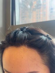 -碧莲盛·不剃发植发