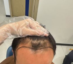 -大麦微针植发全国连锁