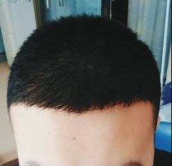 -大麦微针植发全国连锁