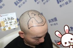 点击看大图 -大麦微针植发丨全国连锁