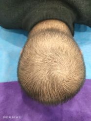 -碧莲盛·不剃发植发