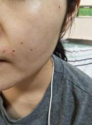-北京美痣堂古方祛痣斑疣瘊