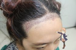 -大麦微针植发丨全国连锁