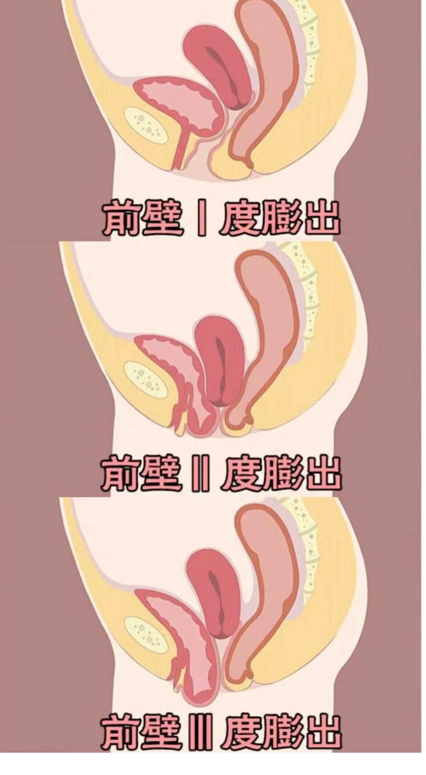 女性膀胱下垂图 下坠图片