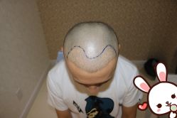 点击看大图 -大麦微针植发丨全国连锁