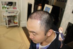 -大麦微针植发丨全国连锁