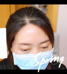 体验后-大麦微针植发全国连锁