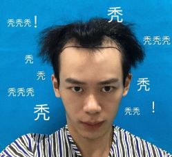 -碧莲盛·不剃发植发