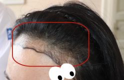 -大麦微针植发全国连锁