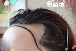 -大麦微针植发全国连锁