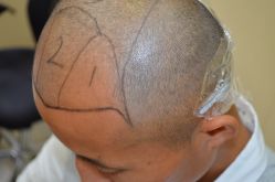 -大麦微针植发丨全国连锁