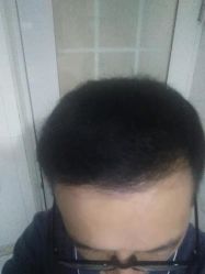 体验后-大麦微针植发全国连锁