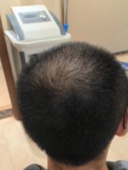 -碧莲盛·不剃发植发