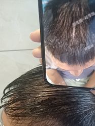 -碧莲盛·不剃发植发