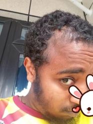 点击看大图 -大麦微针植发丨全国连锁