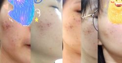 -瓷肌博士·祛痘科技美肤