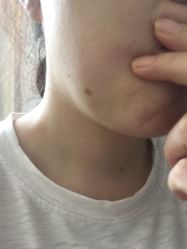 -爱莎扁平疣·汗管瘤·斑痣中心