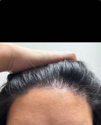 -大麦微针植发丨全国连锁