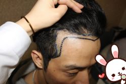 -大麦微针植发丨全国连锁