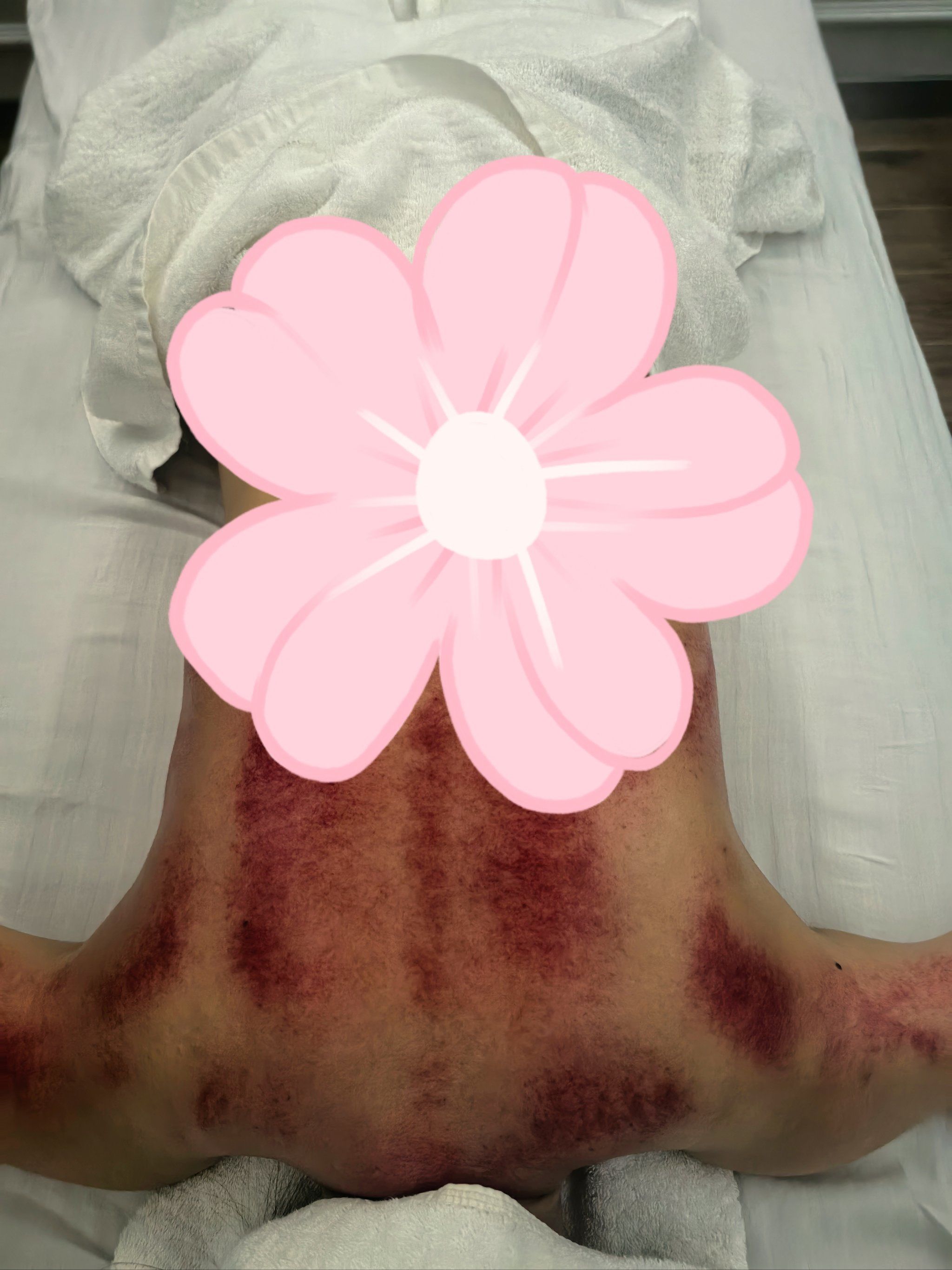 夏日刮痧刮出一背的痧