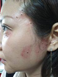 -北京美痣堂古方祛痣斑疣瘊