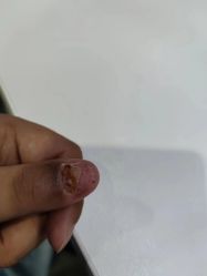 -德哥灰指甲脚气甲沟炎跖疣护理